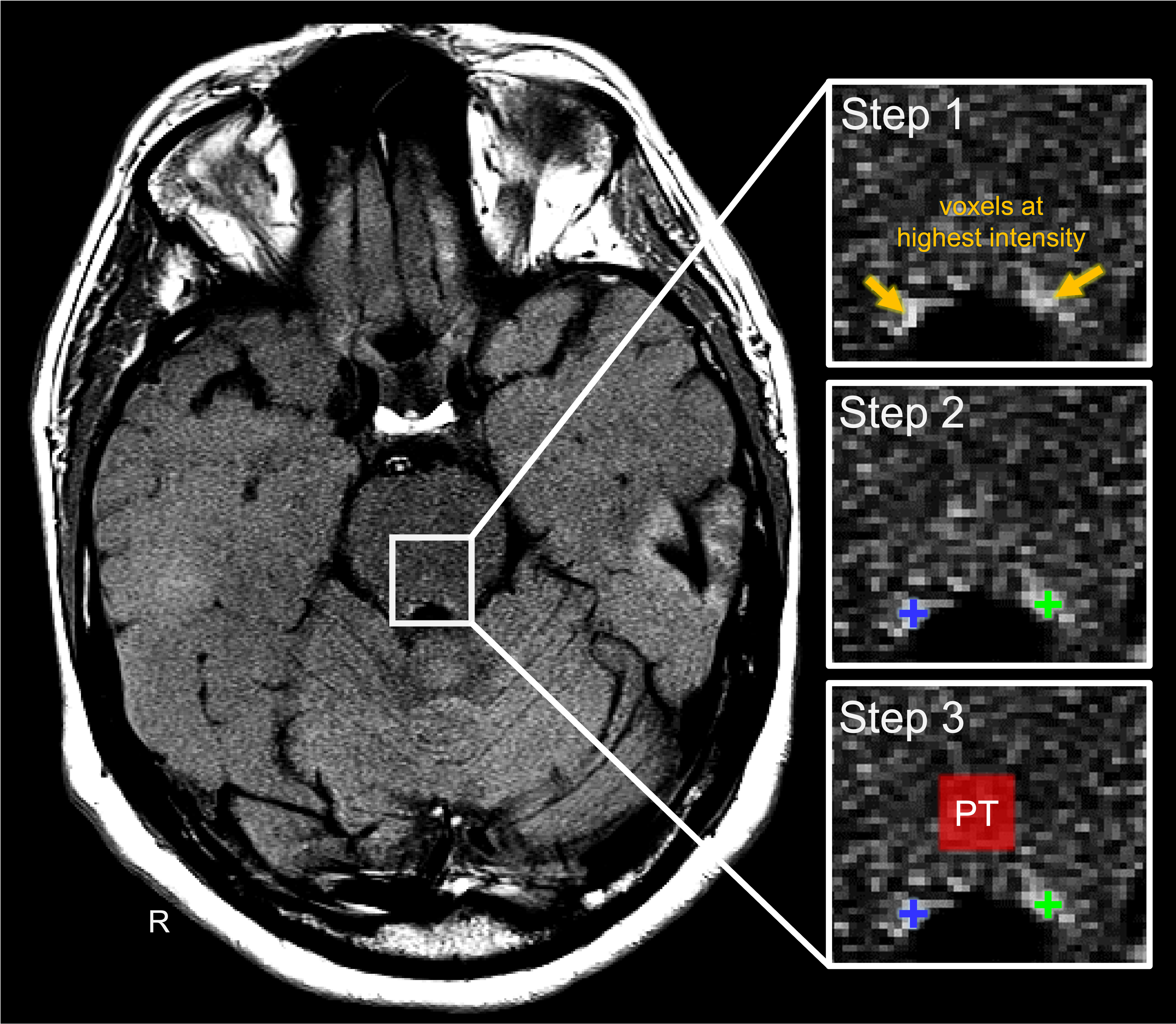 Inversed association of locus coeruleus MRI integrity with structural volume and its impact on individual’s inattentiveness